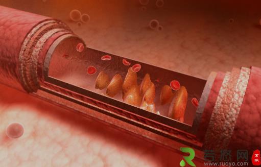 血管变硬竟然是猝死的信号 3步做好动脉硬化的防治