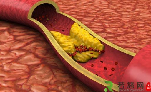 血管变硬竟然是猝死的信号 3步做好动脉硬化的防治