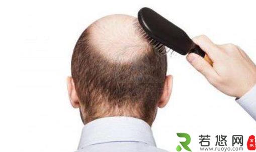 男人为什么容易掉头发 常换洗发水易脱发