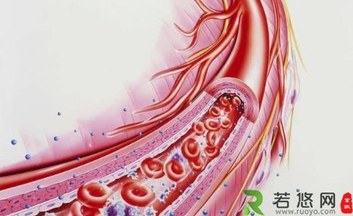 七类人重点防血栓 冲走血栓防住六成血管病 