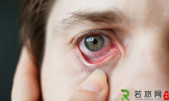 红血丝总是青睐你的眼部和脸上 要怎么有效摆脱红血丝的困扰