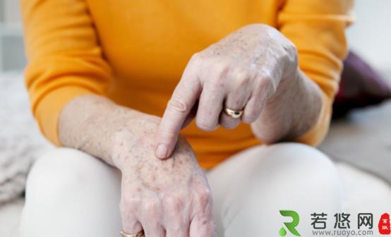 老人手上长老年斑怎么办 缓解老年斑的食疗法