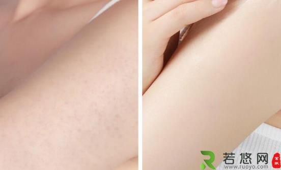 皮肤粗糙的症状有哪些 日常如何预防皮肤粗糙